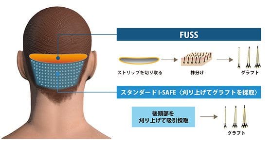 FUSS ストリップを切り取る&ddotrahd;株分け&ddotrahd;グラフト スタンダードi-safe(刈り上げてグラフトを採取) 後頭部を刈り上げて吸引&ddotrahd;グラフト