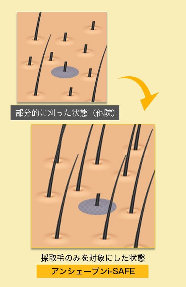 刈り上げない自毛植毛アンシェーブンi-SAFE